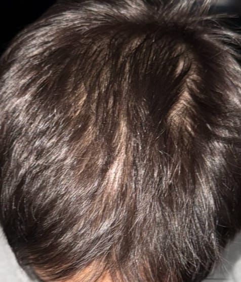 Después del tratamiento de Gabriel