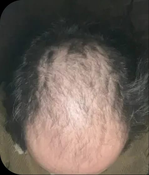 Antes del tratamiento de Roberto, 26