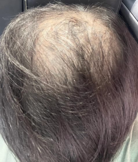 Antes del tratamiento de Gabriel