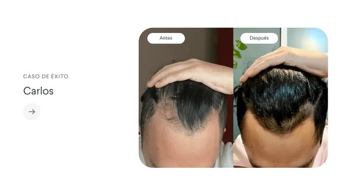 El éxito de Carlos con Finoxidil®