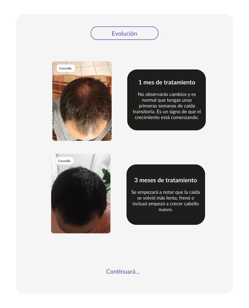 dutaxidil exito