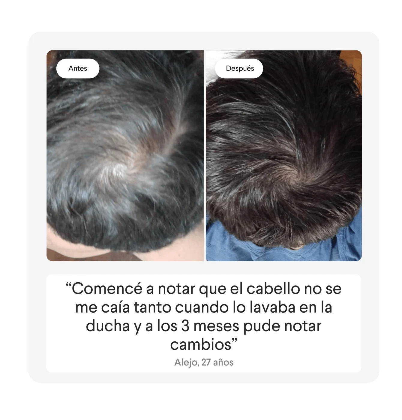 Reseña de alopecia