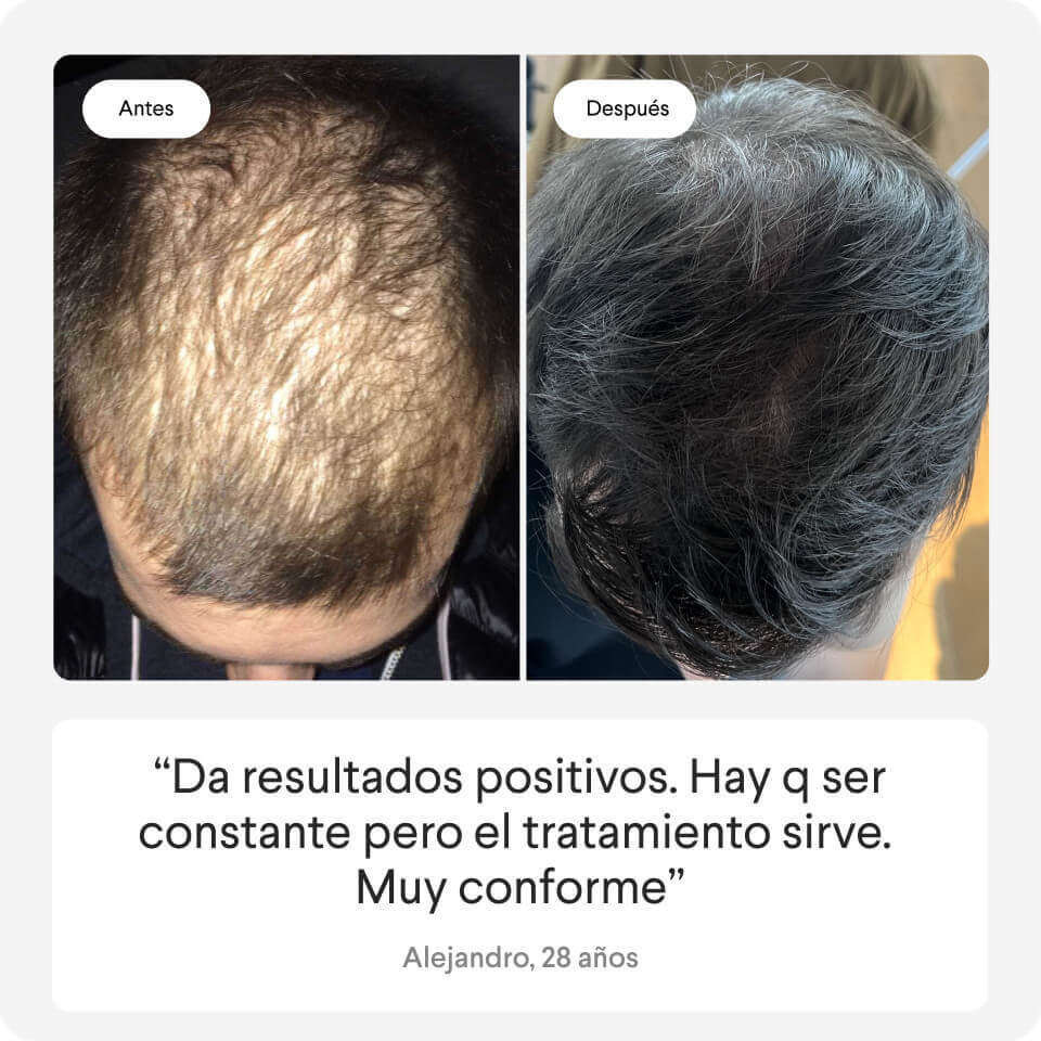 alopecia